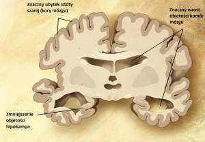 Mózg osoby z chorobą Alzheimera